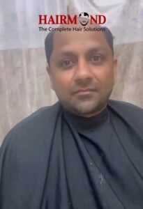 Hair Patch Price in Delhi